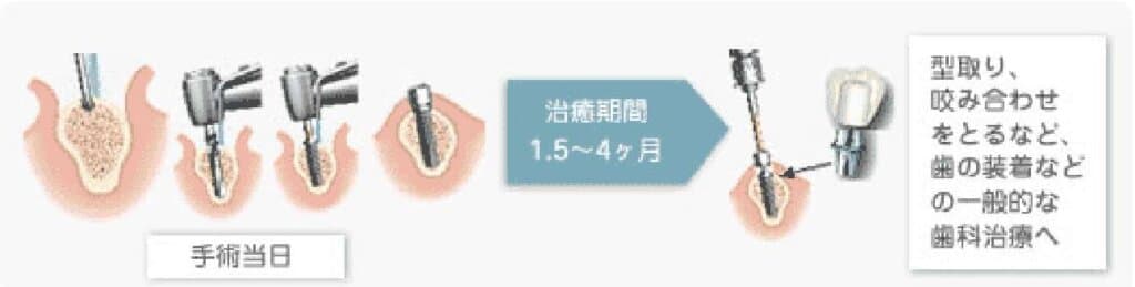 １回法