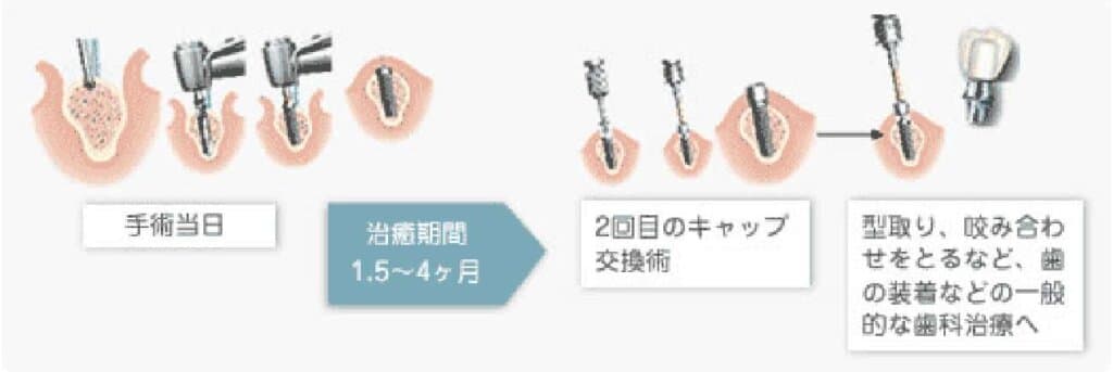 ２回法