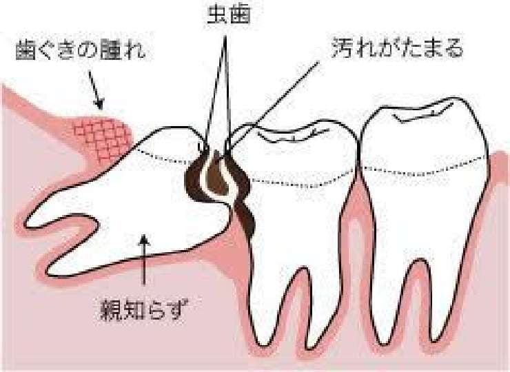 親知らずと虫歯の図