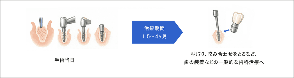 1回法