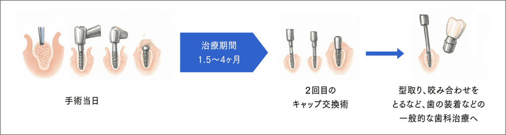 2回法