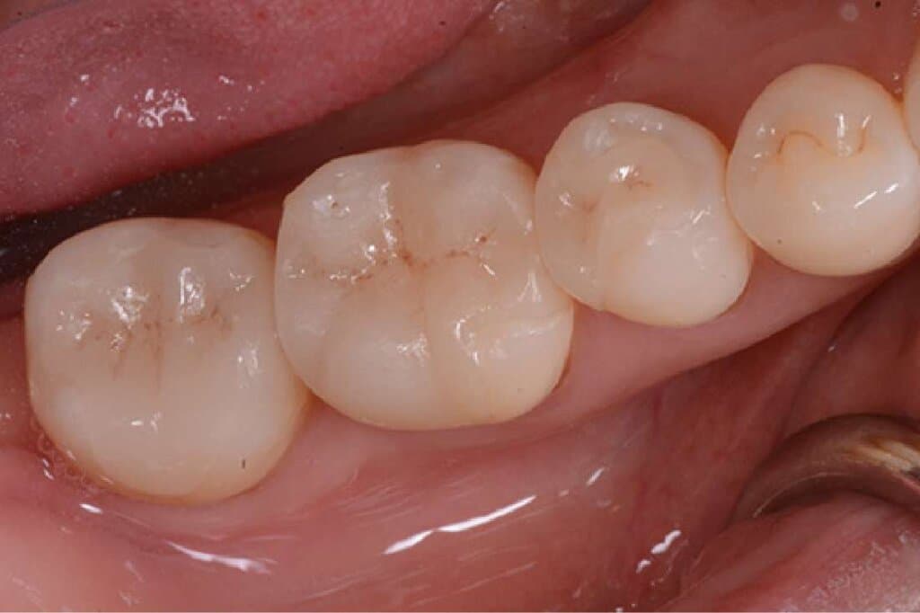 ハイブリッドセラミック(超硬質レジン)