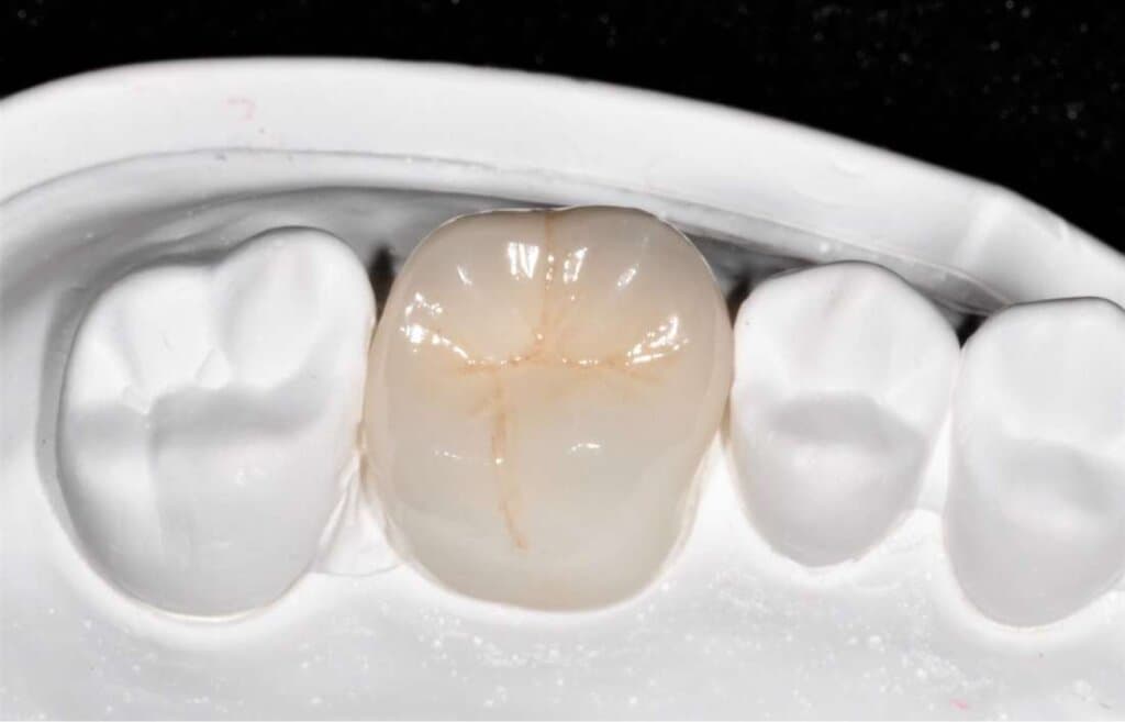 オールセラミッククラウン(フルジルコニア)