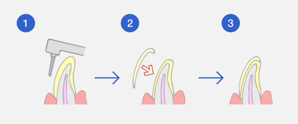 ラミネートベニア
