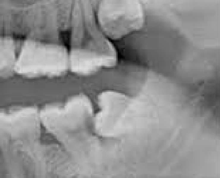 親知らずが原因で手前の歯がむし歯になった症例