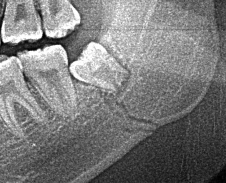 顎の骨折に親知らずが関係している症例