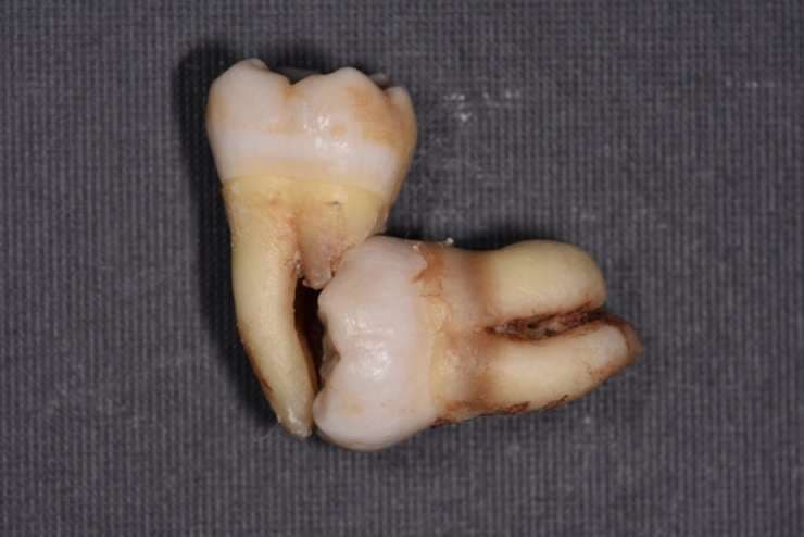 親知らずが原因で手前の歯も抜歯になった症例